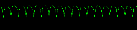 EKG — Pulseless Ventricular Tachycardia
