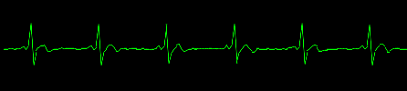 EKG — Sinus rhythm