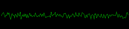 EKG — Ventricular Fibrillation